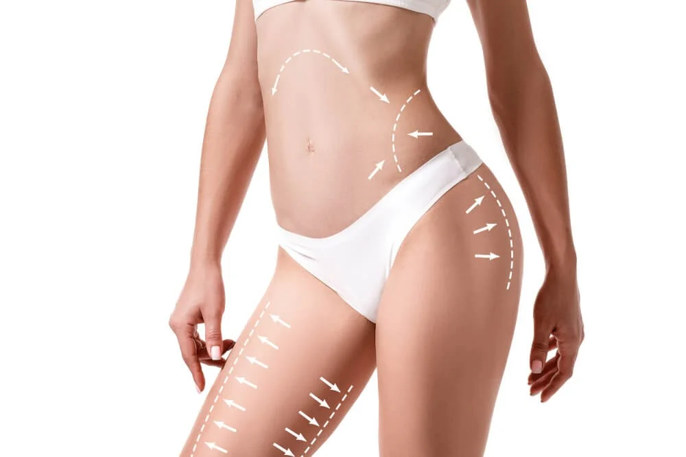 Women's body with trace lines where liposuction is performed in tijuana